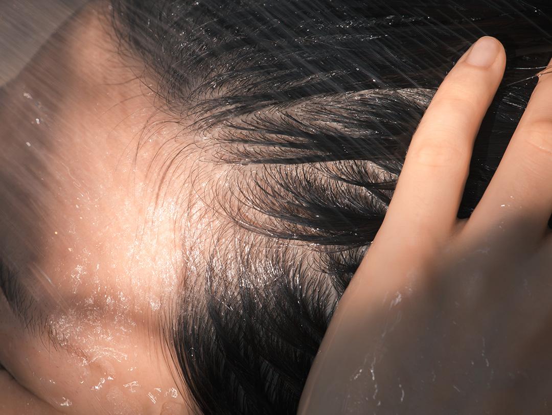 best-scalp-treatments-header