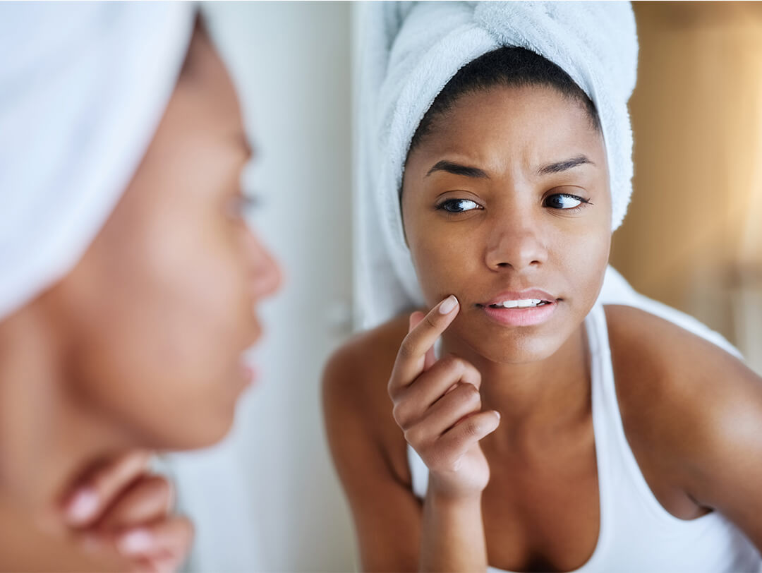Aspirin for Acne: Does It Work? | IPSY