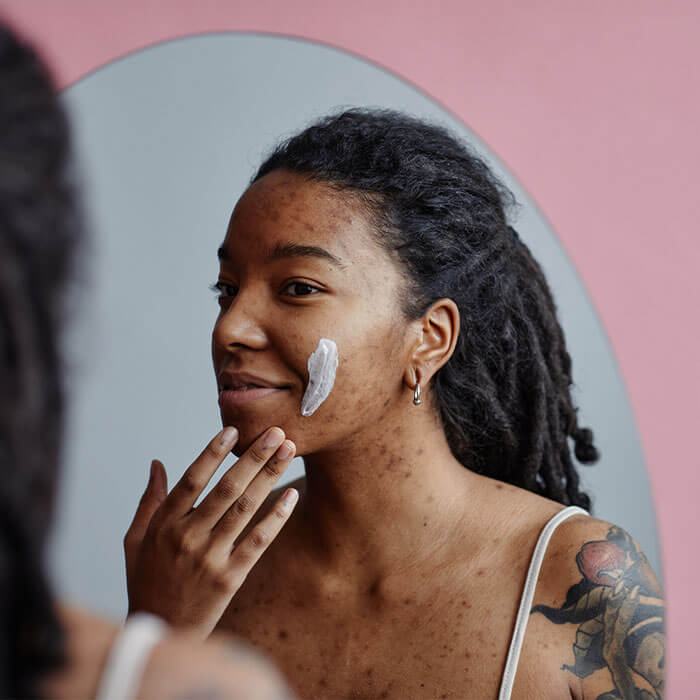 A young black woman with visible acne is seen applying a retinol-based cream to her cheek in front of a mirror, illustrating a dermatologist-recommended skincare practice for acne